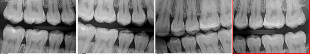 Dental X-ray collection showing 4 different views of the teeth