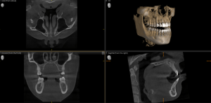 CBCT  (cone beam computed tomography) dental images with 4 three-dimensional images of teeth, jaws, and surrounding structures.